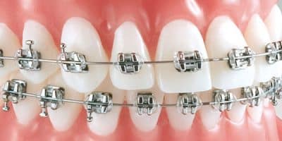 Modelos más comunes de ortodoncia