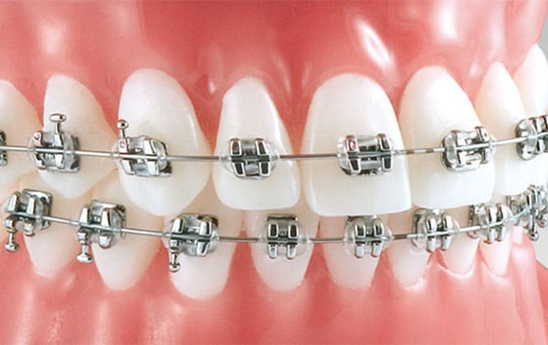 Modelos más comunes de ortodoncia